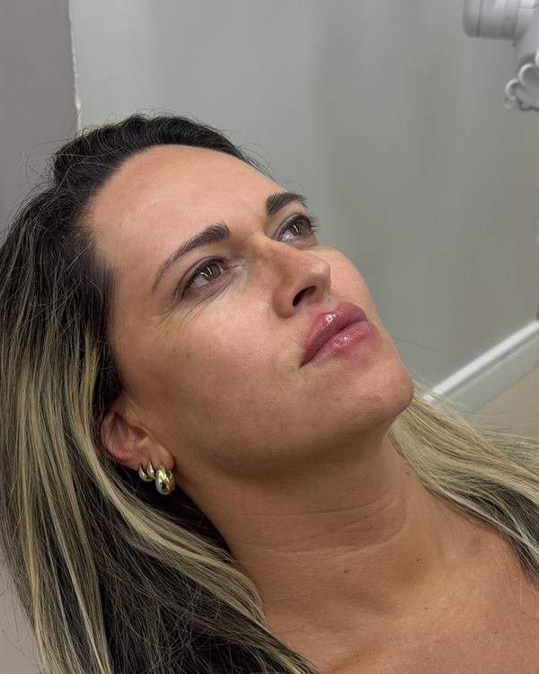 Mesma paciente em três quartos, logo após o procedimento