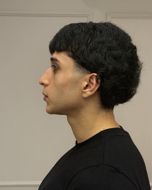 Paciente de perfil, antes do procedimento