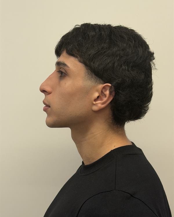 Mesmo paciente de perfil, logo após o procedimento