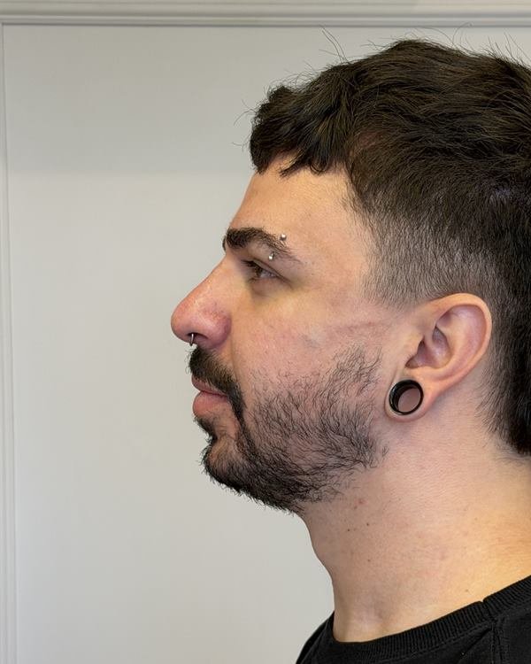 Mesmo paciente de perfil, logo após o procedimento