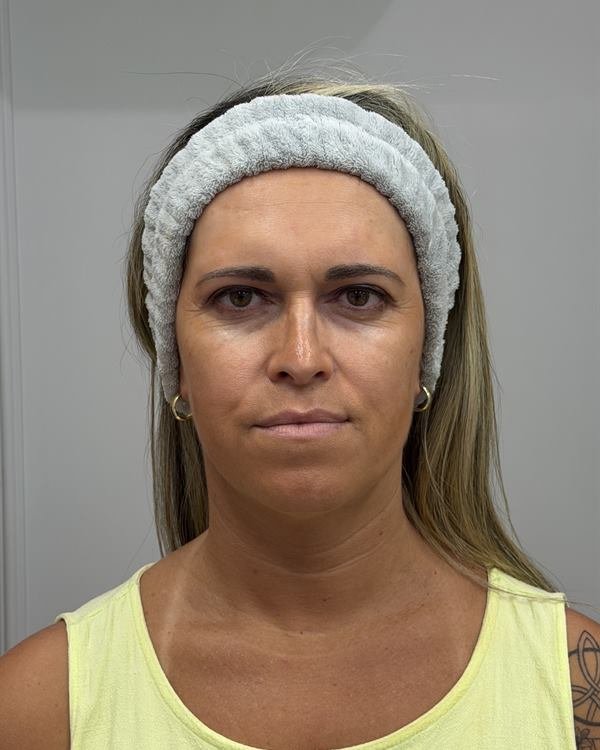 Paciente de frente, antes do procedimento